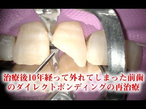 治療後10年経って外れてしまった前歯のダイレクトボンディングの再治療