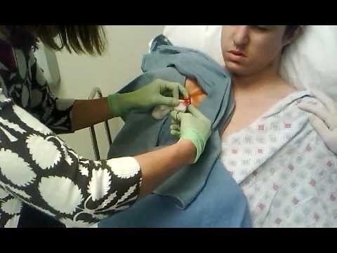 Dialysis Catheter Removel