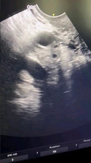 SSG or Sonosalpingography.