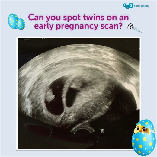 9.6K views · 62 reactions | Can you spot twins on an early pregnancy...