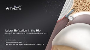 Labral Hip Refixation