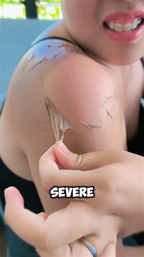 Instructions for burn wound first aid 🆘