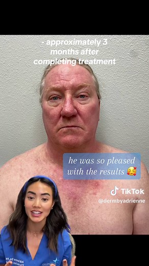 Efudex (fluorouracil/5-FU) works wonders against actinic keratoses! The treatment duration is tailored to your needs, guided by your healthcare provider and the extent of sun damage. For more extensive cases, it could stretch over several months, personalized just for you 🌞 My heartfelt gratitude to my brave patient who shared their remarkable journey with us! 🙌🏽 #EfudexJourney #SkinHealth #dermatology #dermatologist #skincancer #humor #funny #actinickeratosis #skincare #beauty #beautyroutine