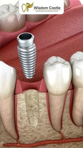 Dental Implant vs Bridge: Best Solution for a Single Missing Tooth