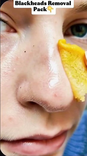Remove Blackheads & Whiteheads Fast 👃✨Get cleaner pores and smoother-looking skin naturally 🧖‍♀️🖤