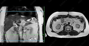 MRI of the upper abdomen axial view is a non-invasive imaging technique providing detailed visuals of organs like the liver, pancreas, and kidneys.