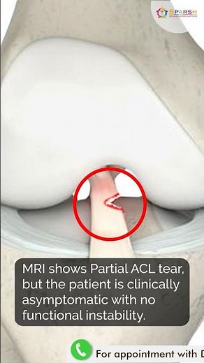 MRI Shows Partial ACL Tear… But Surgery Is NOT Always Needed! #aclinjury #partialacltear #acl
