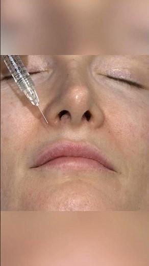 Use this simple needle trick for smoother vertical lip injections