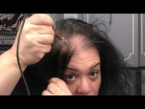 MICRO NEEDLING MY BALD SCALP FOR EXTREME HAIR GROWTH FAST