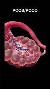 PCOS | PCOD | Ovary Disease | #pathology #3danimation