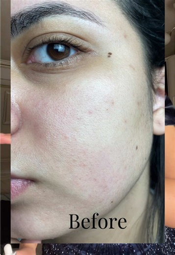 مسام البشرة: كيف تسدها بالضبه والمفتاح