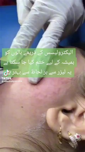 #doctor #foryou #faithandfreedomelectrolysis #trending #electrolysis #viralvideo