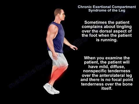 Chronic Exertional Compartment Syndrome - Everything You Need To Know - Dr. Nabil Ebraheim