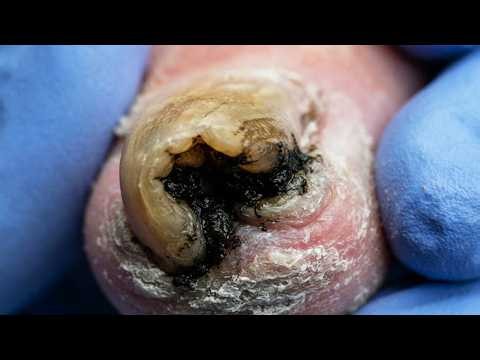 Restoring Clean Nails: Step By Step Trimming Of Deformed Toenails【Dr. Liu's Pedicur】