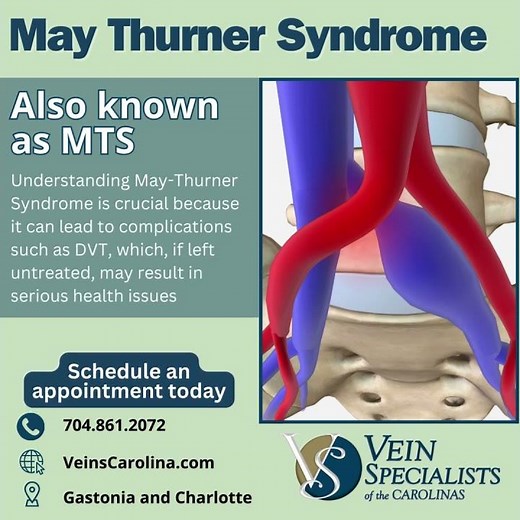 Understanding May Thurner Syndrome: A Closer Look