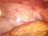 Peritoneal Tuberculosis in laparoscopy • Video • MEDtube.net