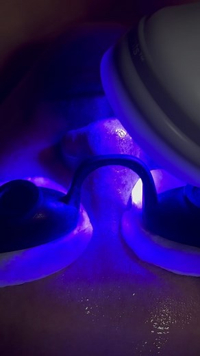 what does LED light therapy do? Can treat acne eczema psoriasis hair loss wrinkles & sun damage! BLUE light affects the uppermost layer of the skin and is great for killing bacteria that causes acne. | reezyesthetics