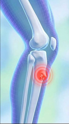 Why You Have This BumpBelow Your Knee🦶#OsgoodSchlatter #KneeBump#MedicalAnimation #Anatomy #Puberty