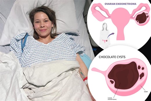 What is a chocolate cyst? The growth Bindi Irwin had removed — along with 51 lesions and her appendix