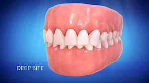 Check out this video and find out how malocclusion or poor bite affects your teeth and smile. If you have this kind of teeth, you can message us here on Facebook and Dr. James will give you his professional advice. | Dr. James Dental Clinic