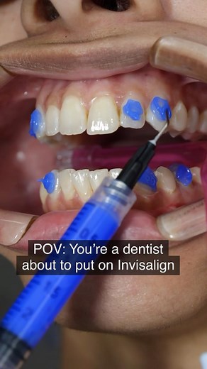 Invisalign attachments