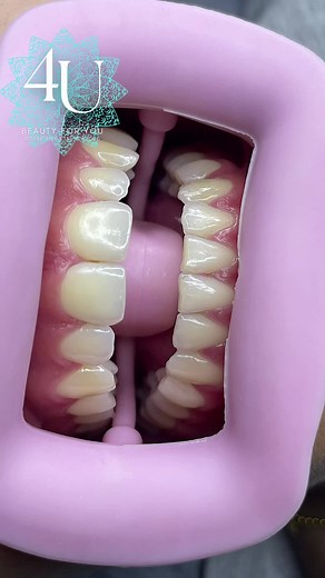 #blanchiment #blanchimentdentaire #smile #dentsblanches #beauty #sourire #dentaire #teethwhitening #teeth #whiteteeth #whitesmile #perfectsmile #dents #white #dentiste #soin #dent #hollywoodsmile #dentist #dentblanche #blanchimentdesdents #aesthetic #soins #blanc #blanchimentdentaireamericain #microneedling #dentalphotography #instagram #montrealteethwhitening