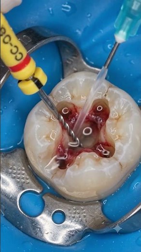 Root Canal Treatment Step by Step 🦷 | Tooth Repair Animation in 3D | Dental Restoration Process