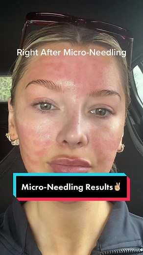 My Micro-Needling Experience: Week Journey and Results
