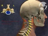 Hyperextension and Central Cord Syndrome • Video • MEDtube.net