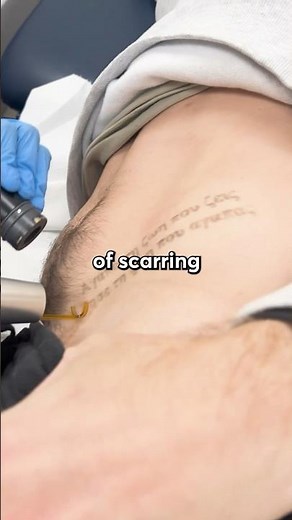 Scarring after Laser Tattoo Removal | #tattooremoval #tattooed #skincare