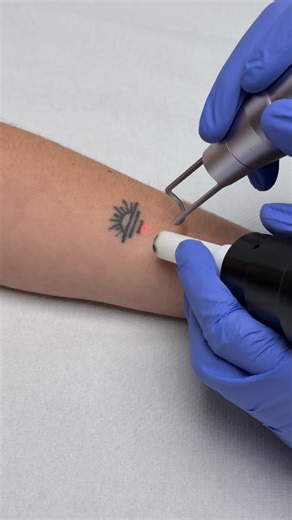 Lo pequeño también puede ser para siempre... a menos que pases por nuestras manos. ✨ A veces, un tatuaje pequeño que ya no nos representa puede molestar más que uno grande. La buena noticia es que, con la precisión de nuestra Ink Hunter, las sesiones son muy rápidas y efectivas. En pocos minutos fragmentamos el pigmento y dejamos que tu cuerpo haga el resto. ¡Adiós a ese detalle que ya no quieres ver! ¿Tienes un tatuaje pequeño que quieres eliminar? Pásanos una foto por WhatsApp y te damos presu