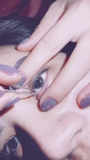 Biggest ingrown hair on the eye 👁️ #blackheadtoolkit #blackhead #satisfying #acne #pimple #fyp