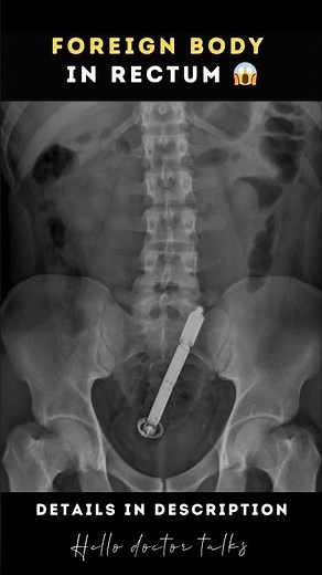 Foreign Body in Rectum Details in description 👍 #healthchannel #doctor #doctorslife #askdoctor #doc