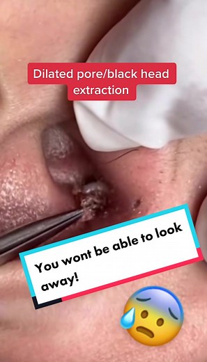 Dilated pore/blackhead removal. #blackhead #acne #blackheadremoval #whitehead #dilatedpore #acne #whiteheadremoval #oddlysatisfying #extractions