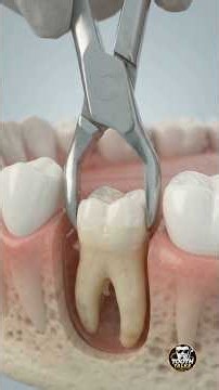 What Really Happens During Wisdom Tooth Removal? 🦷 | Step-by-Step Dental Procedure #shorts