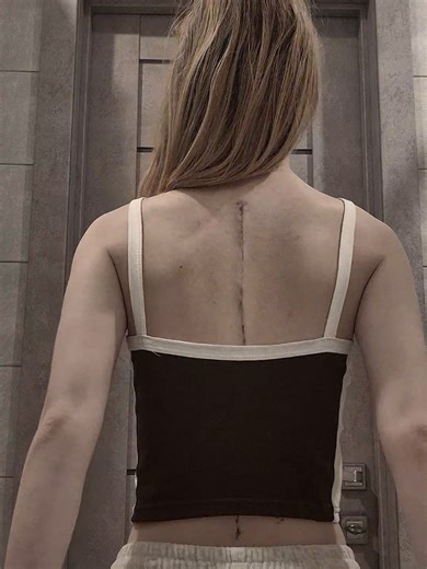 #операция #сколиоз #спина | surgery