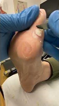 Watch Podiatrist Debride Wart After Salicylic Acid Treatment | Hard Skin Removal with Docpods