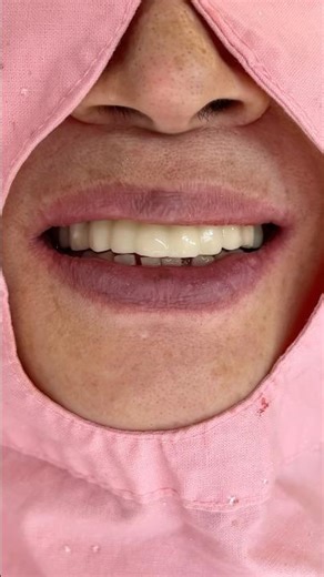부분틀니 제거후 전체임플란트 수술후 임시치아 #dentist #dental #dentalclinic #dentistry #하루에치과 ￼