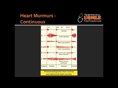 Heart Murmurs - Patent Ductus Arteriosus (PDA)