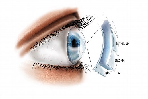 Fuchs endothelial corneal dystrophy: for patients - Gene Vision