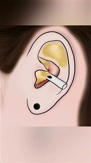 Can AirPods Cause Ear Abscess? 🎧 | Hidden Danger of Earbuds
