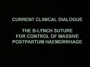 Surgery for Postpartum Hemorrhage