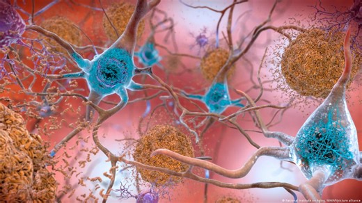 New drug shows promise against Alzheimer's