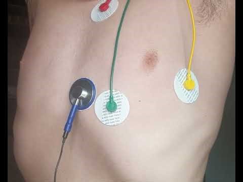 Steady tachycardia heartbeat sound subj.-b1