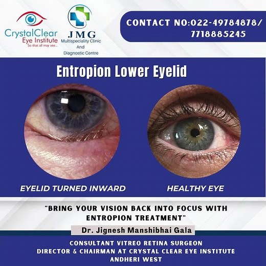 Entropion correction ‪@crystalcleareyeinstitute6612‬ ‪@crystalcleareyehospital‬ by DR Jignesh Gala
