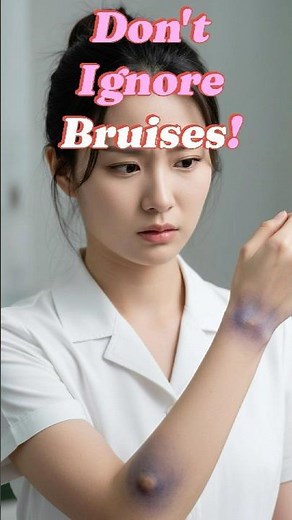 Don't Ignore Bruises! They Might Indicate a Blood Issue #health #wellness #blood