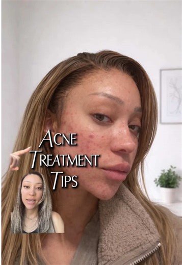 K-Beauty Masks Transform Acne for Women of Color