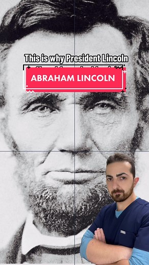 If you think you may have a vertical strabismus or any other type of BVD, look for a binocular vision specialist in your area that can help … #bvd #binocularvisionmatters #abrahamlincoln #verticalstrabismis #trauma #concussion