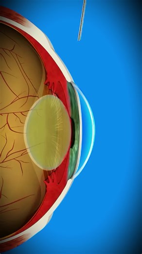 Cataract Surgery Explained: Quick Path to Clear Vision
