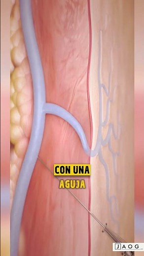 How to remove varicose veins without surgery